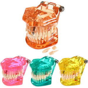 Dental Implant Disease Teeth Model with Restoration Bridge Dentist for Medical Science Teaching