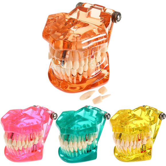 Dental Implant Disease Teeth Model with Restoration Bridge Dentist for Medical Science Teaching