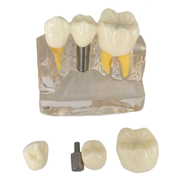 4X Denture Disease Teeth Model Toy Caries Decay Tooth For Dental Medical Demo Communication Teaching