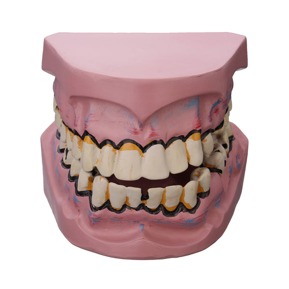 Dental Disease Teeth Model Oral Tooth Model Smoking Harm Disease Teeth Implantation Medical Model